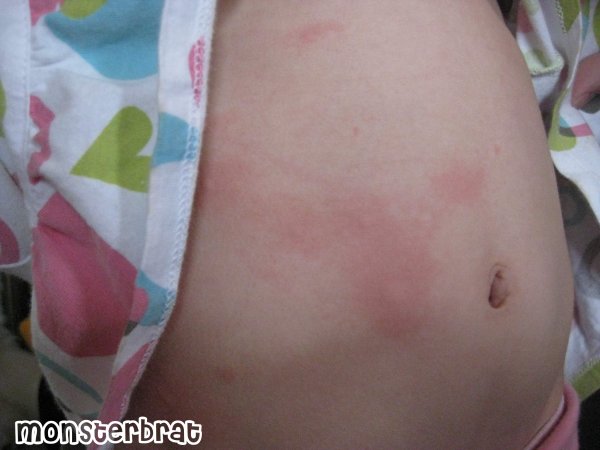 hives2