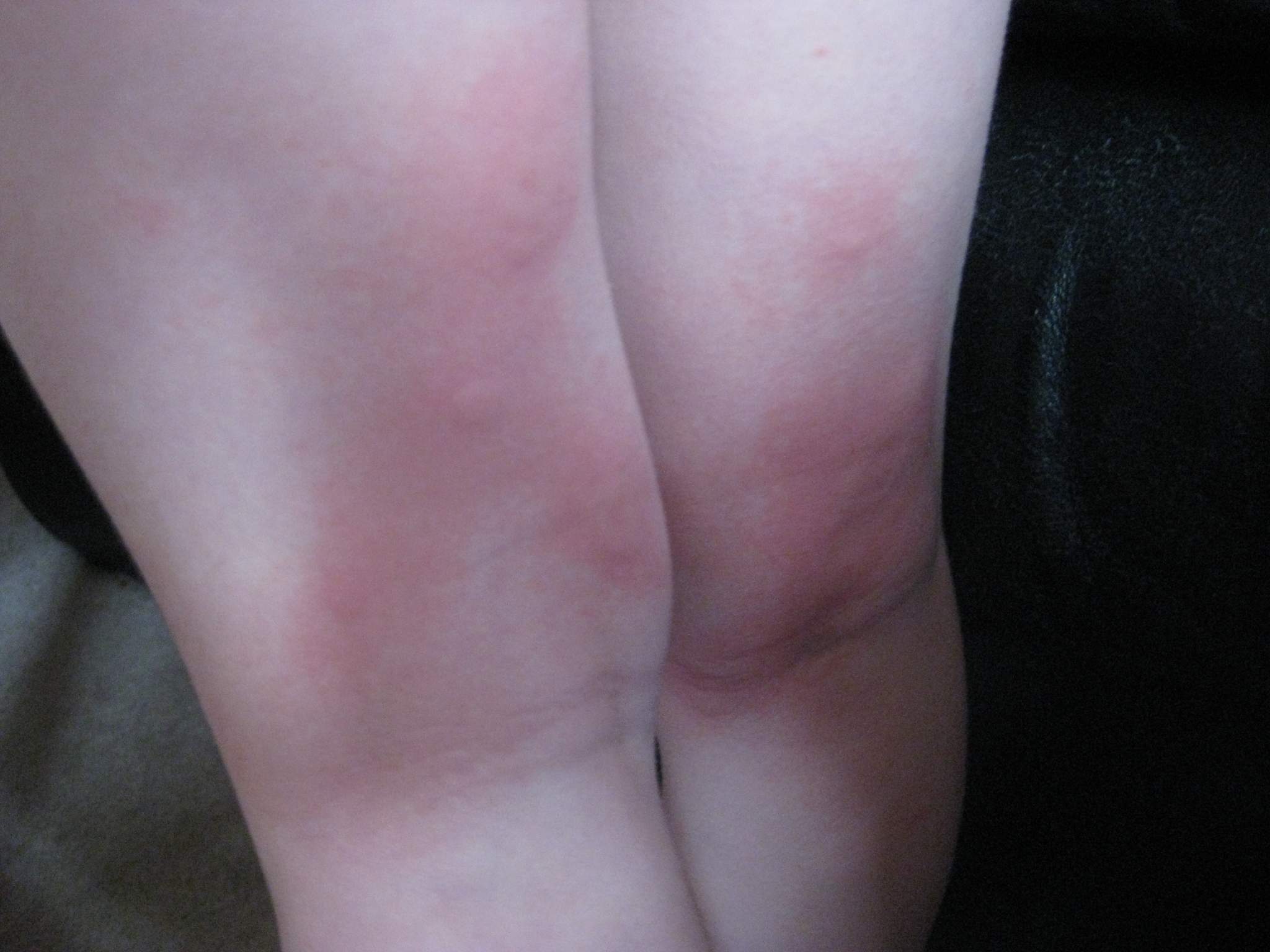 hives4